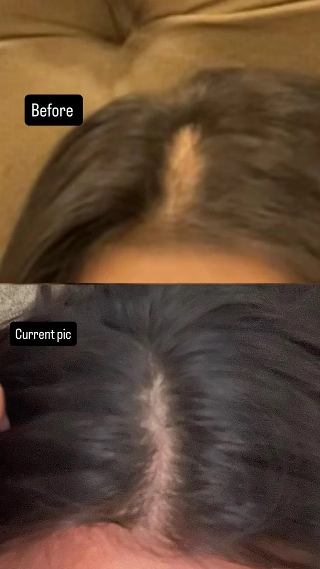 Before/after photo of a satisfied user after 5 months of Aminexil treatment